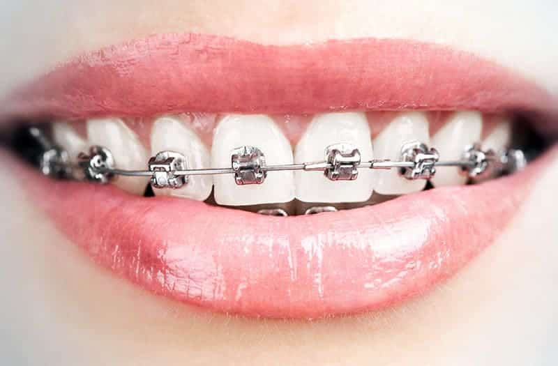 Bagues Vestibulaires DAMON®