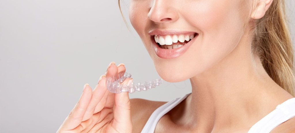 Aligners transparents Invisalign